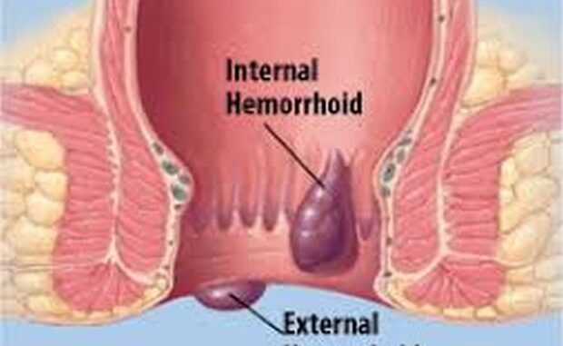 hemoroid